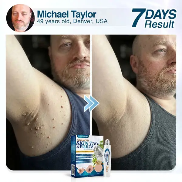 Advanced Skin Tag & Wart Removal Roller - Image 5