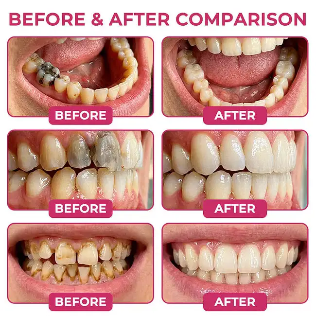 DenPerm Cavity-Repair Advanced Enamel Filling Gel - Image 2