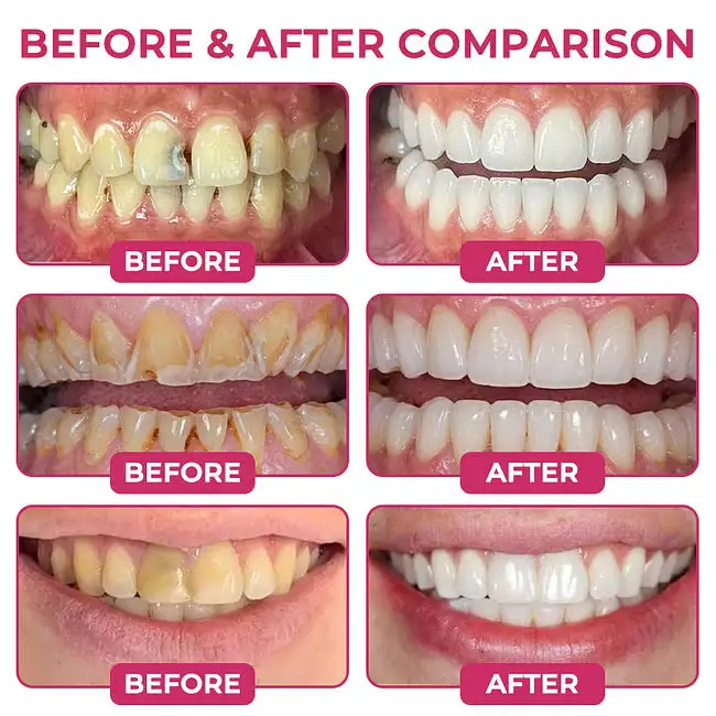 DenPerm Cavity-Repair Advanced Enamel Filling Gel - Image 3