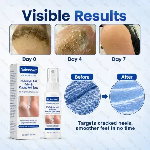 Medical-Grade 2% Salicylic Acid Callus & Cracked Heel Repair Spray - Image 8
